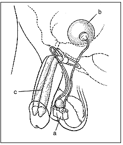 impotence information-Figure of Implant