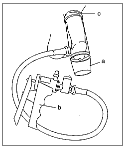 Impotence information-figure showing Vacuum pump
